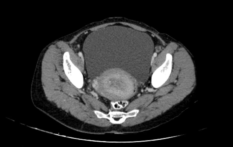 File:Non-puerperal uterine inversion (Radiopaedia 78343-91094 A 25).jpg