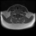 Normal cervical and thoracic spine MRI (Radiopaedia 35630-37156 Axial T1 C+ 14).png