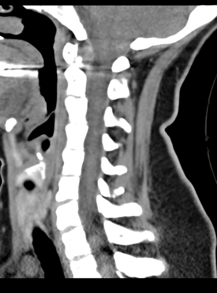 File:Normal cervical spine MRI (including Dixon) (Radiopaedia 42762-45926 C 35).png