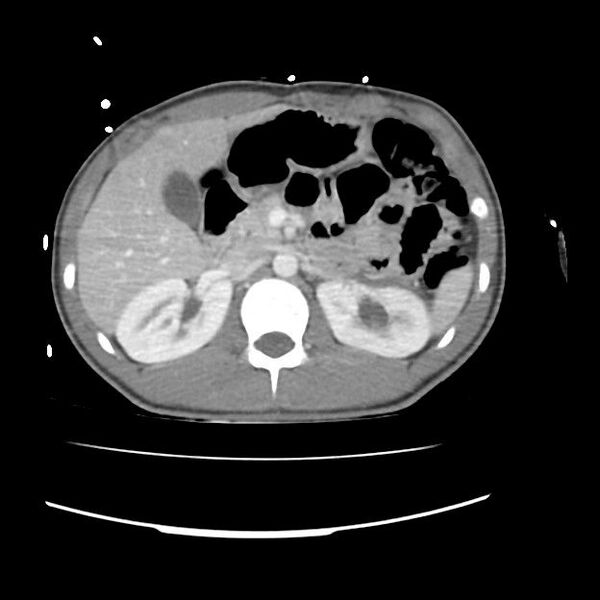 File:Normal dual-phase trauma CT chest,abdomen and pelvis (Radiopaedia 48092-52899 A 61).jpg