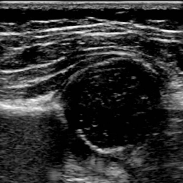 File:Normal hip ultrasound - infant (Radiopaedia 2718-6410 C 1).jpg