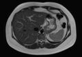 Normal liver MRI with Gadolinium (Radiopaedia 58913-66163 Axial T2 24).jpg
