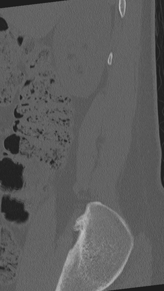 File:Normal lumbar spine CT (Radiopaedia 46533-50986 Sagittal bone window 94).png