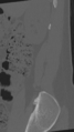 Normal lumbar spine CT (Radiopaedia 46533-50986 Sagittal bone window 94).png