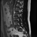 Normal lumbar spine MRI (Radiopaedia 35543-37039 Sagittal T2 10).png