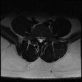 Normal lumbar spine MRI (Radiopaedia 47857-52609 Axial T2 22).jpg