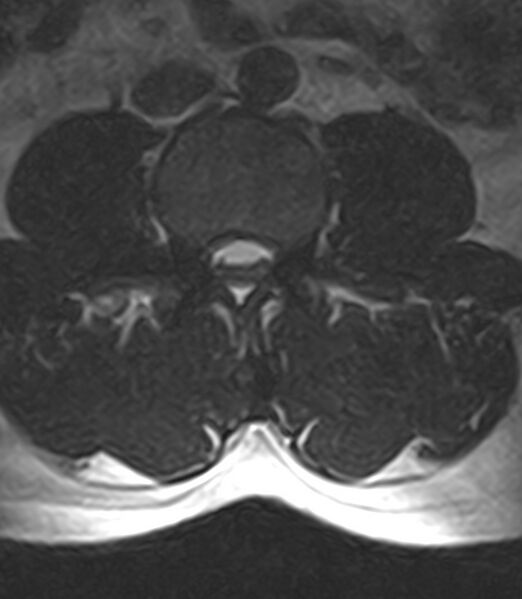 File:Normal lumbar spine MRI - low-field MRI scanner (Radiopaedia 40976-43699 Axial T2 52).jpg