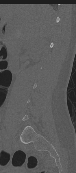 File:Normal lumbosacral CT (Radiopaedia 37923-39867 Sagittal bone window 72).png