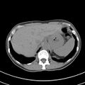 Normal multiphase CT liver (Radiopaedia 38026-39996 Axial non-contrast 12).jpg