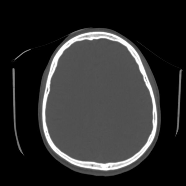 File:Occipital spur - asymptomatic (Radiopaedia 87753-104201 Axial bone window 135).jpg