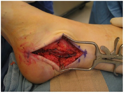 Intraoperative image demonstrating the medial approach and exposure of the flexor hallucis longus tendon