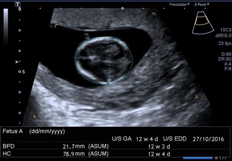 File:1st trimester nuchal-morphology ultrasound (Radiopaedia 44706-48477 General anatomy and NT 11).jpg