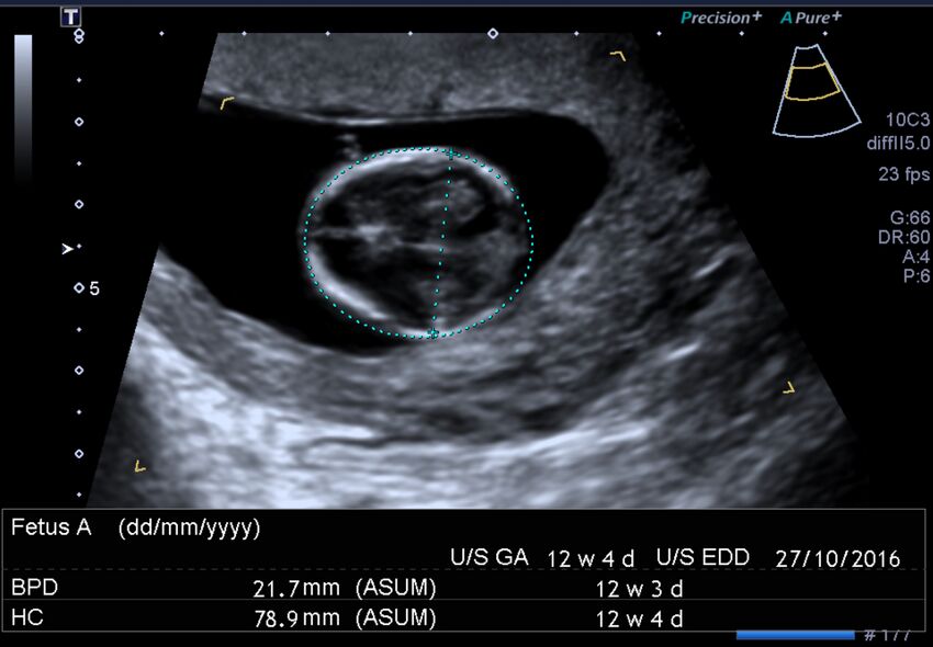 1st trimester nuchal-morphology ultrasound (Radiopaedia 44706-48477 General anatomy and NT 11).jpg