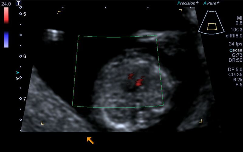 File:1st trimester nuchal-morphology ultrasound (Radiopaedia 44706-48477 Heart views cine with colour 91).jpg