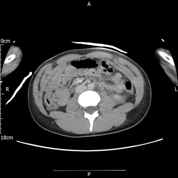 File:AAST grade IV kidney injury with CEUS follow-up (Radiopaedia 72353-82877 Axial C+ portal venous phase 36).jpg