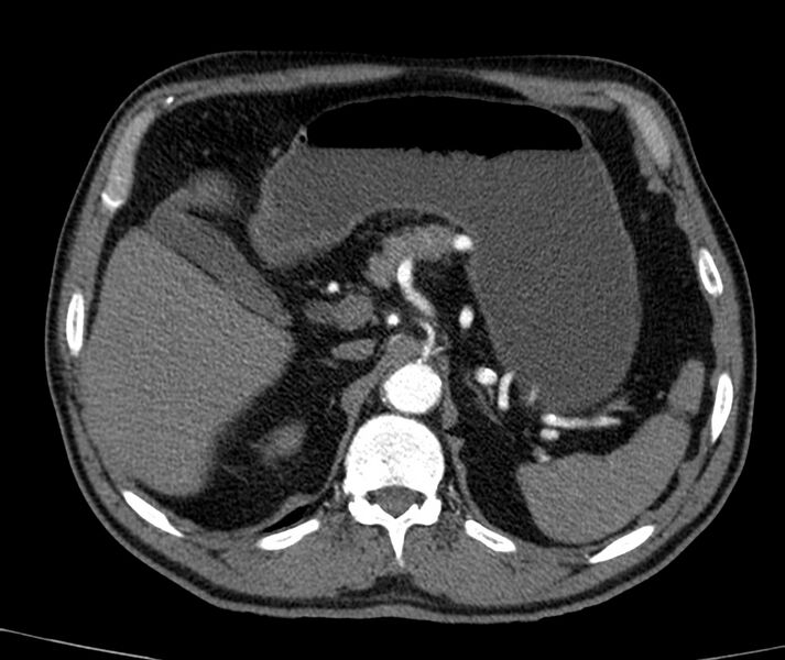 File:Abdominal aortic aneurysm (Radiopaedia 22421-22458 C+ arterial phase 13).jpg