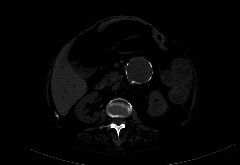 File:Abdominal aortic aneurysm - impending rupture (Radiopaedia 19233-19246 B 6).jpg