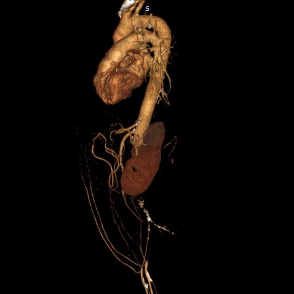 File:Abdominal aortic interposition tube graft and aneurysm thrombosis (Radiopaedia 71438-81857 3D VRT C+ arterial phase 5).jpg