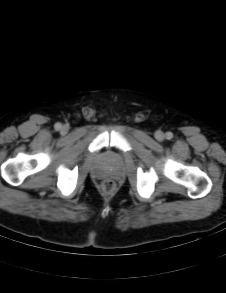 File:Abdominal lymphoma - with sandwich sign (Radiopaedia 53486-59492 Axial C+ portal venous phase 51).jpg
