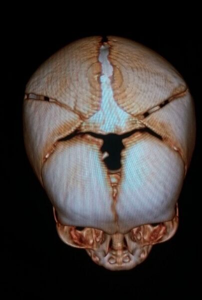 File:Accessory intraparietal suture (Radiopaedia 50584-56021 3D reconstruction 6).jpg