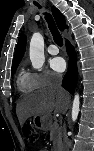 File:Accessory left atrial appendage (Radiopaedia 81987-95968 Sagittal C+ arterial phase 38).jpg
