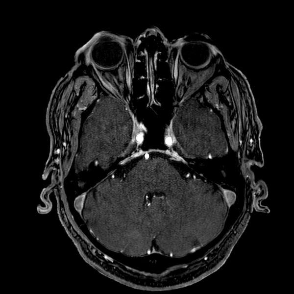 File:Accessory middle cerebral artery (Radiopaedia 73114-83828 Axial MRA 43).jpg