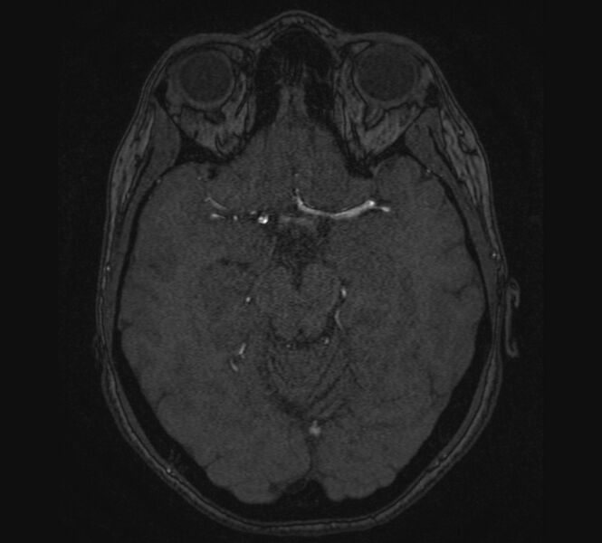 File:Accessory middle cerebral artery and ICA aneurysm (Radiopaedia 22656-22674 MRA 48).jpg