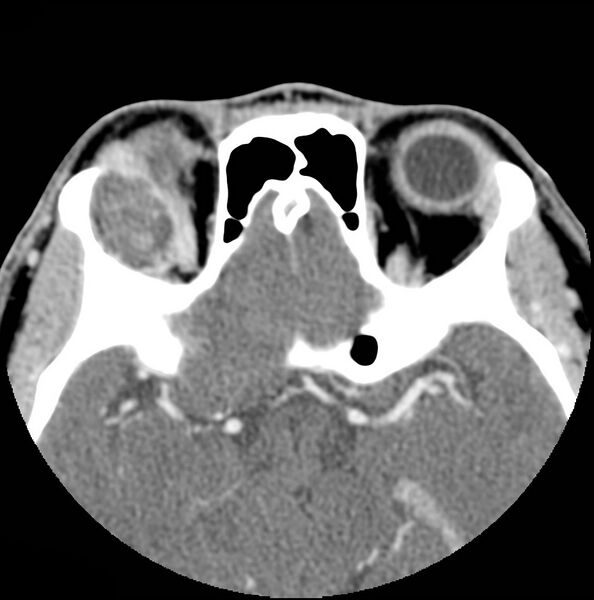File:Acinic cell carcinoma of the lacrimal gland (Radiopaedia 9480-10160 Axial C+ arterial phase 9).jpg