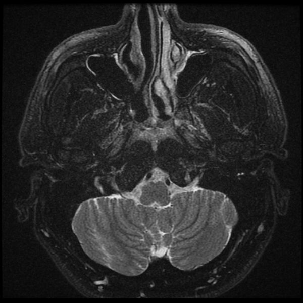 File:Acoustic schwannoma - intracanalicular (Radiopaedia 37247-39024 Axial T2 fat sat 3).jpg