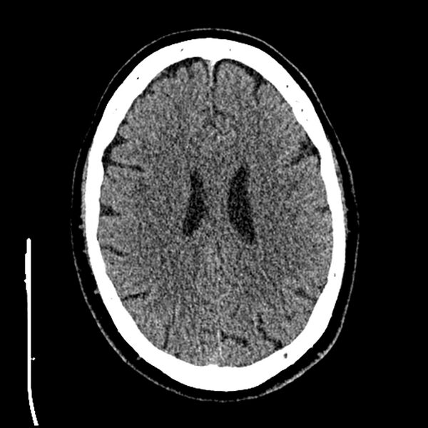 File:Acute A3 occlusion with ACA ischemic penumbra (CT perfusion) (Radiopaedia 72036-82525 Axial non-contrast thins 66).jpg