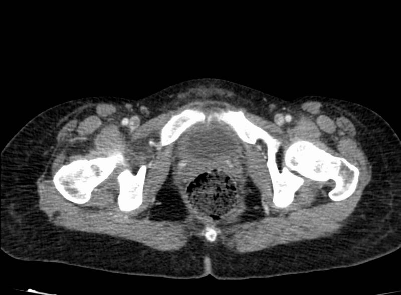 File:Acute Budd-Chiari syndrome (Radiopaedia 60858-68638 Axial C+ portal venous phase 296).jpg