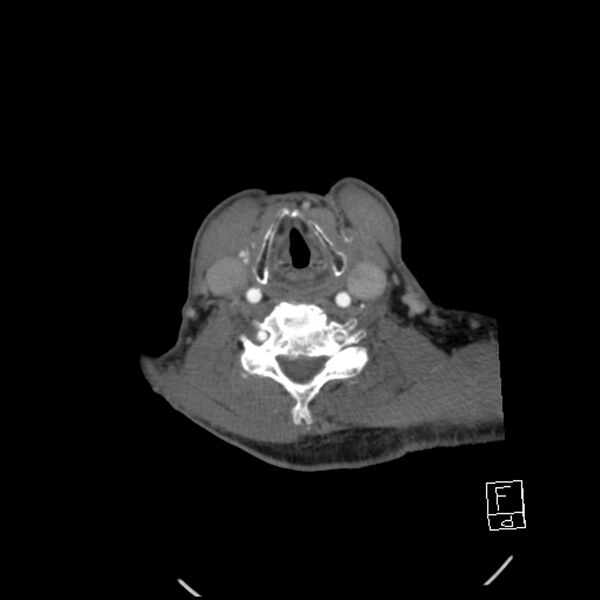 File:Acute ICA ischemic penumbra due to high-grade CCA stenosis (CT perfusion) (Radiopaedia 72038-82530 Axial C+ arterial phase 55).jpg