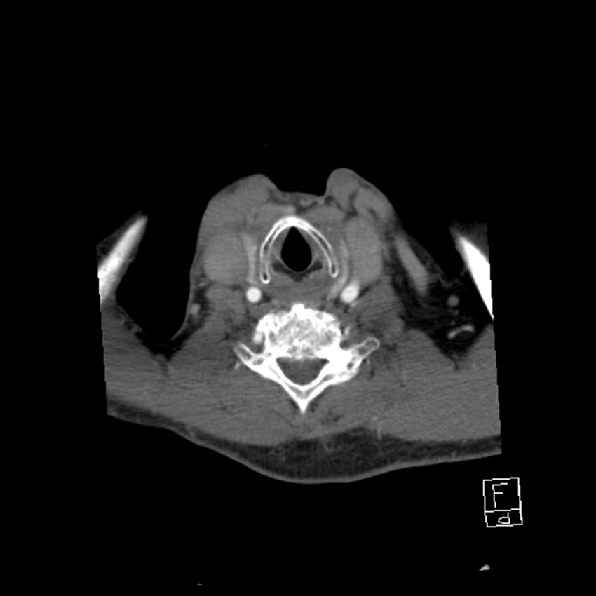 Acute ICA ischemic penumbra due to high-grade CCA stenosis (CT perfusion) (Radiopaedia 72038-82530 Axial C+ arterial phase 59).jpg
