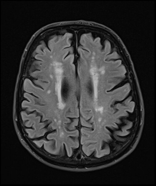 File:Acute P1 occlusion with PCA ischemia penumbra (CT perfusion) (Radiopaedia 72084-82590 Axial FLAIR 26).jpg
