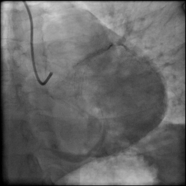 File:Acute anteroseptal myocardial infarction (Radiopaedia 68409-77946 LAO caudal (spider view) LAD and CX 82).jpg