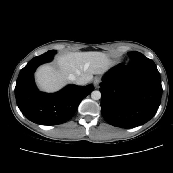 File:Acute appendicitis (Radiopaedia 27049-27227 Axial C+ portal venous phase 8).jpg