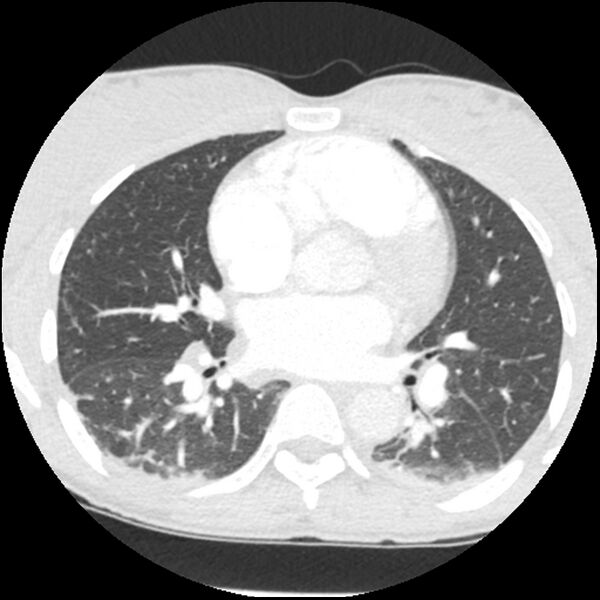 File:Acute chest syndrome - sickle cell disease (Radiopaedia 42375-45499 Axial lung window 102).jpg