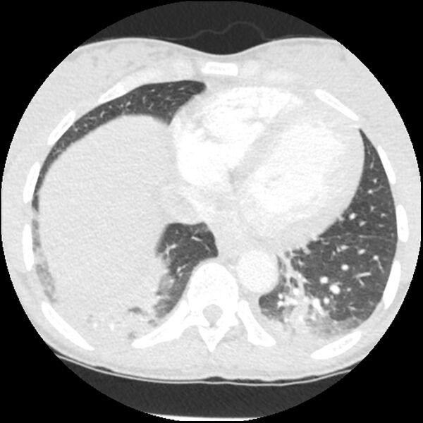 File:Acute chest syndrome - sickle cell disease (Radiopaedia 42375-45499 Axial lung window 144).jpg