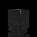 Acute cholecystitis and ureteric colic (Radiopaedia 42330-45444 Coronal prone 11).jpg