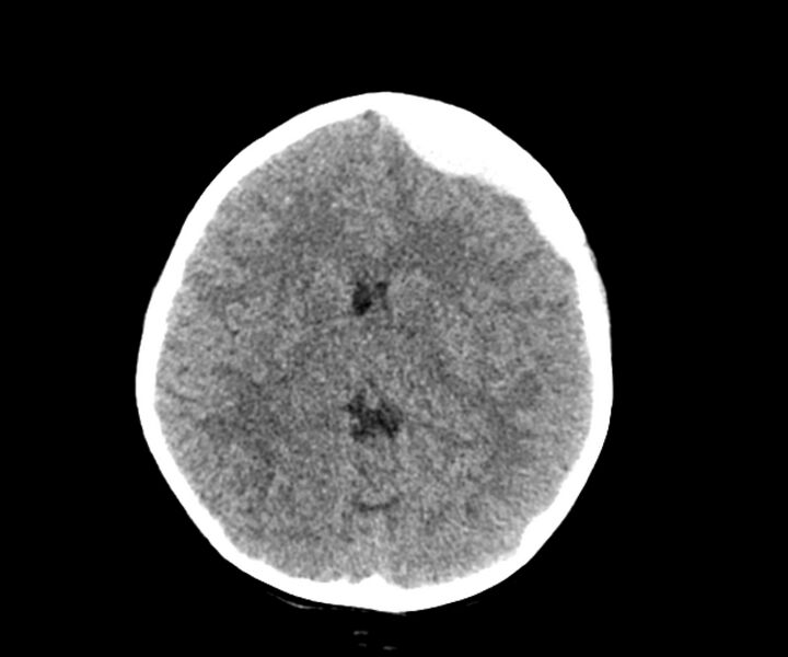 File:Acute epidural hematoma (Radiopaedia 63659-72335 Axial non-contrast 11).jpg