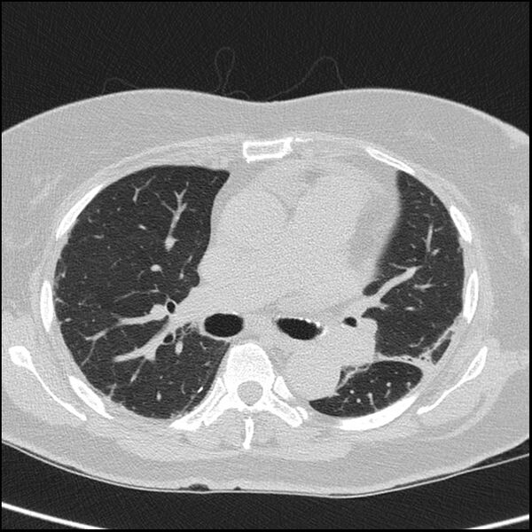 File:Acute interstitial pneumonitis (Radiopaedia 45404-49453 Axial lung window 38).jpg