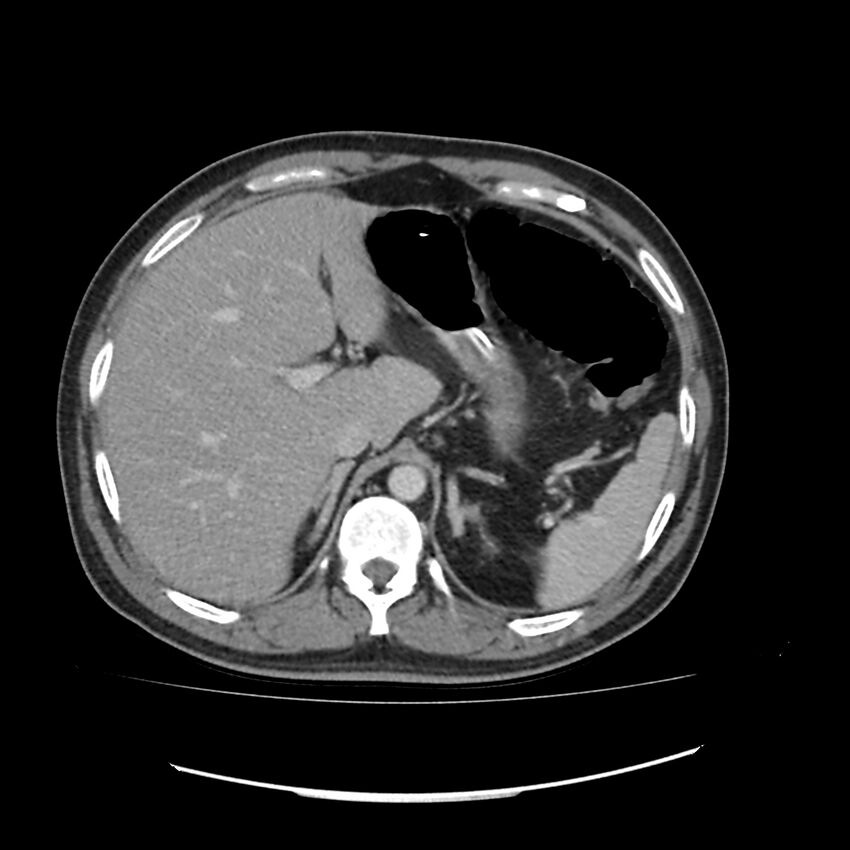 Acute mesenteric ischemia - superior mesenteric artery thrombosis (Radiopaedia 73947-84776 Axial C+ portal venous phase 7).jpg