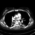 Acute myocardial infarction in CT (Radiopaedia 39947-42415 Axial C+ arterial phase 67).jpg