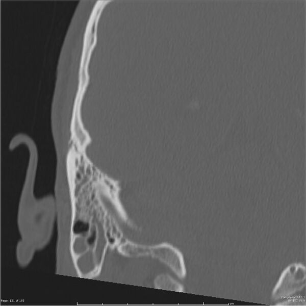 File:Acute otomastoiditis (Radiopaedia 28276-28512 Coronal PTB bone window reformat 52).jpg