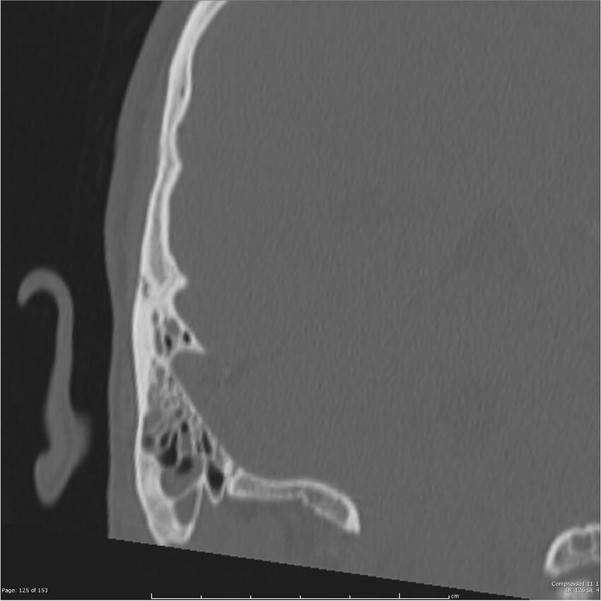 Acute otomastoiditis (Radiopaedia 28276-28512 Coronal PTB bone window reformat 56).jpg