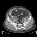 Acute pancreatitis (Radiopaedia 19135-19116 Axial non-contrast 48).jpg