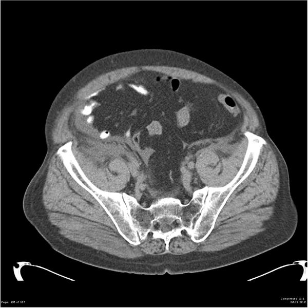 File:Acute pancreatitis (Radiopaedia 19135-19116 Axial non-contrast 48).jpg