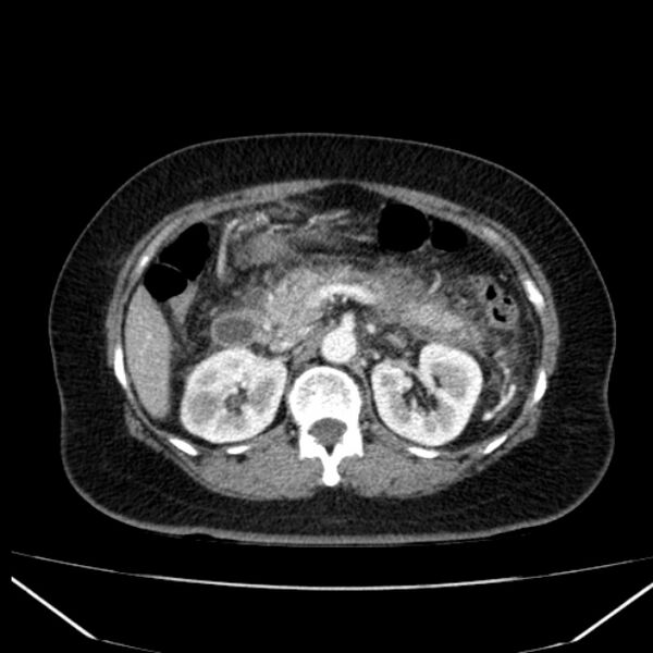 File:Acute pancreatitis - Balthazar C (Radiopaedia 26569-26714 Axial C+ arterial phase 33).jpg