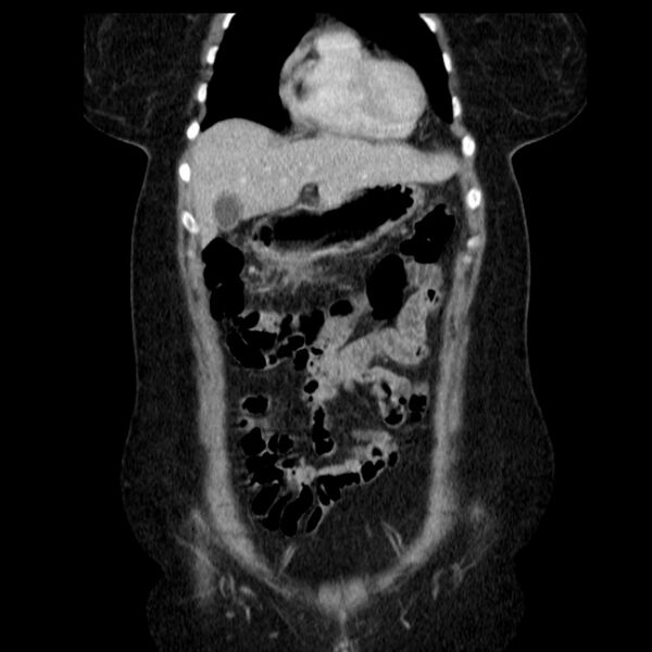 File:Acute pancreatitis - Balthazar C (Radiopaedia 26569-26714 Coronal C+ portal venous phase 21).jpg