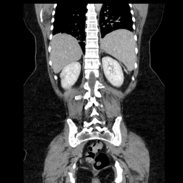 File:Acute pancreatitis - Balthazar C (Radiopaedia 26569-26714 Coronal C+ portal venous phase 51).jpg